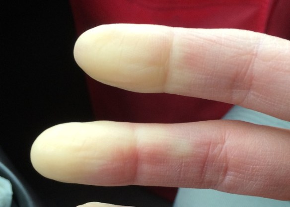 raynauds